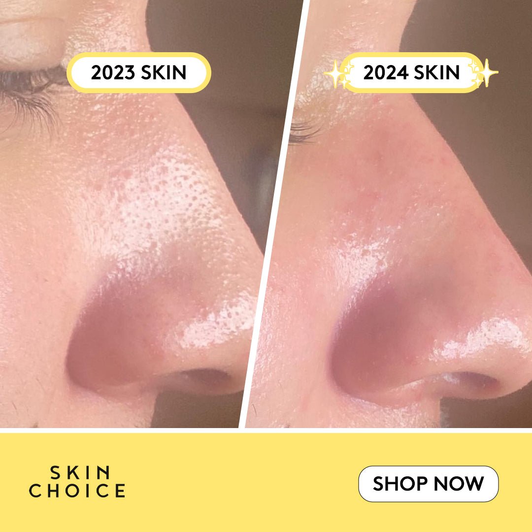 Breakout Patch Classic Nose-3
